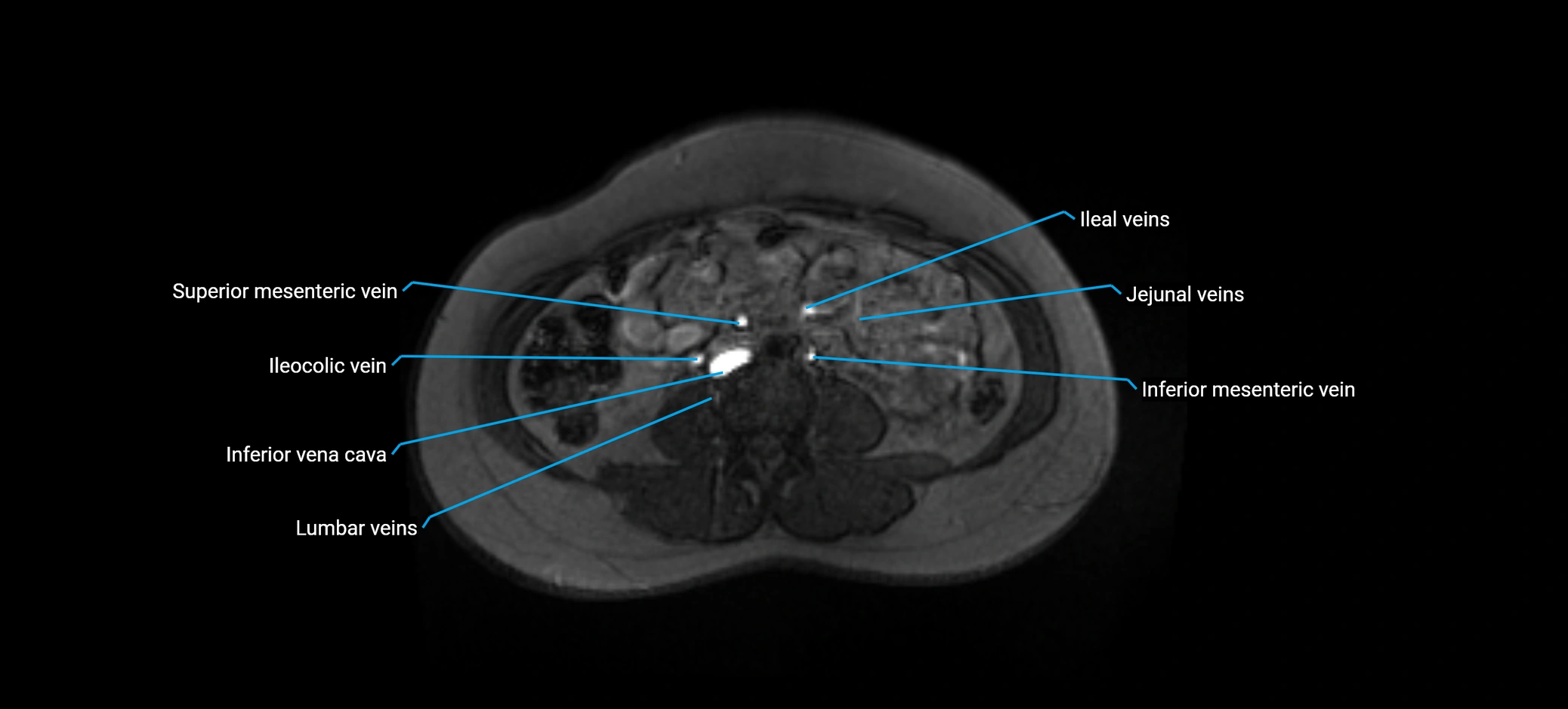 MRV abdomen pelvis & lower limb axial cross sectional anatomy labelled MRI image 102 (1).webp